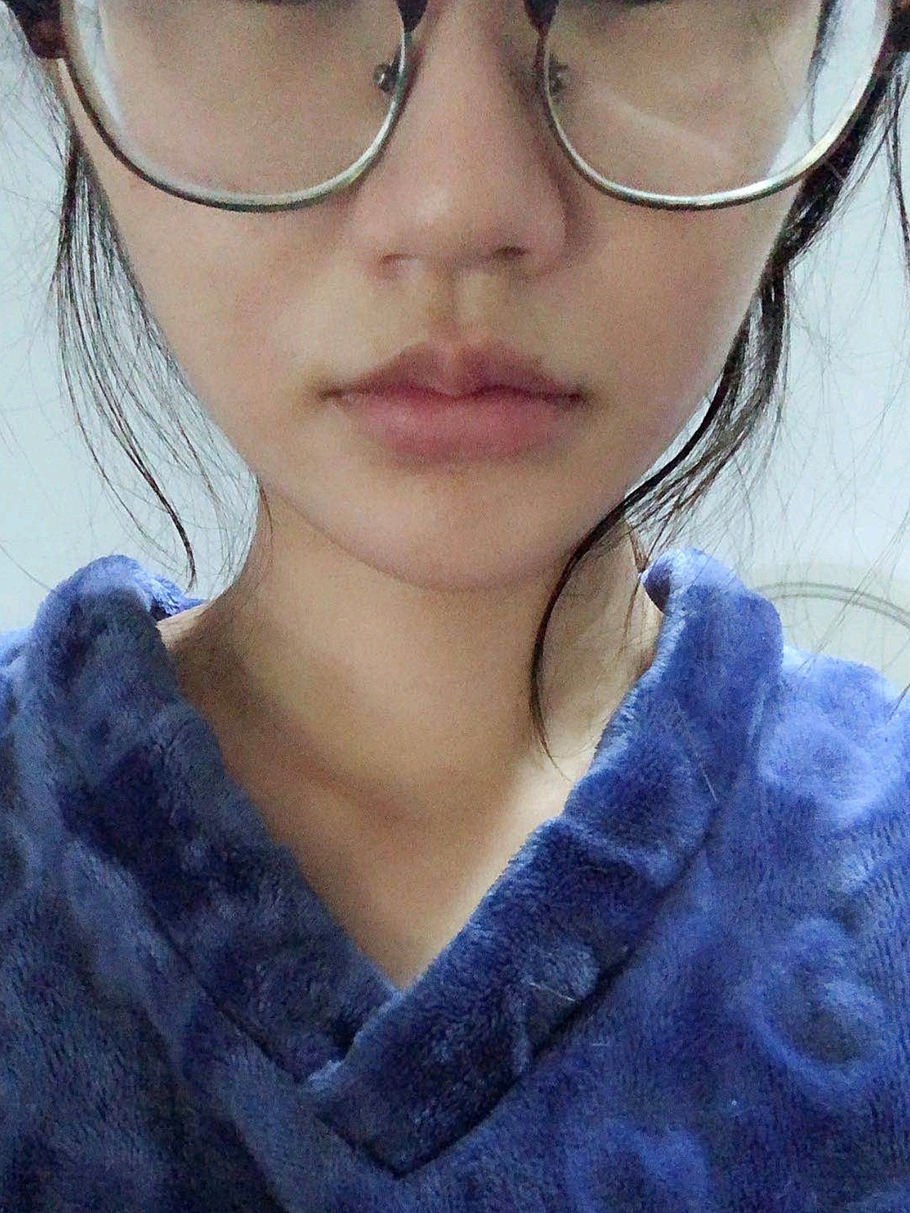 图一是刚取了纱布的时候,两边腮帮子都挺肿的,图二是_圈子-新氧美容