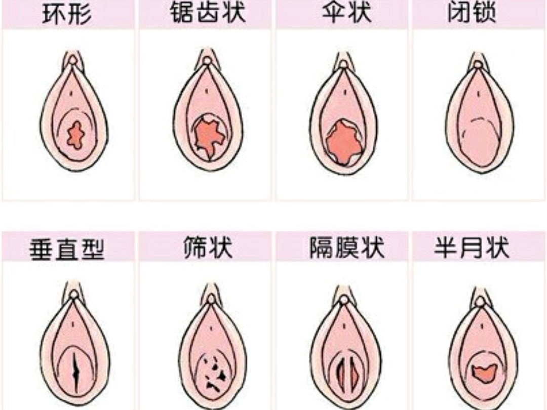 【处女膜修复】目前来说,到医院做手术的可能有这几种.