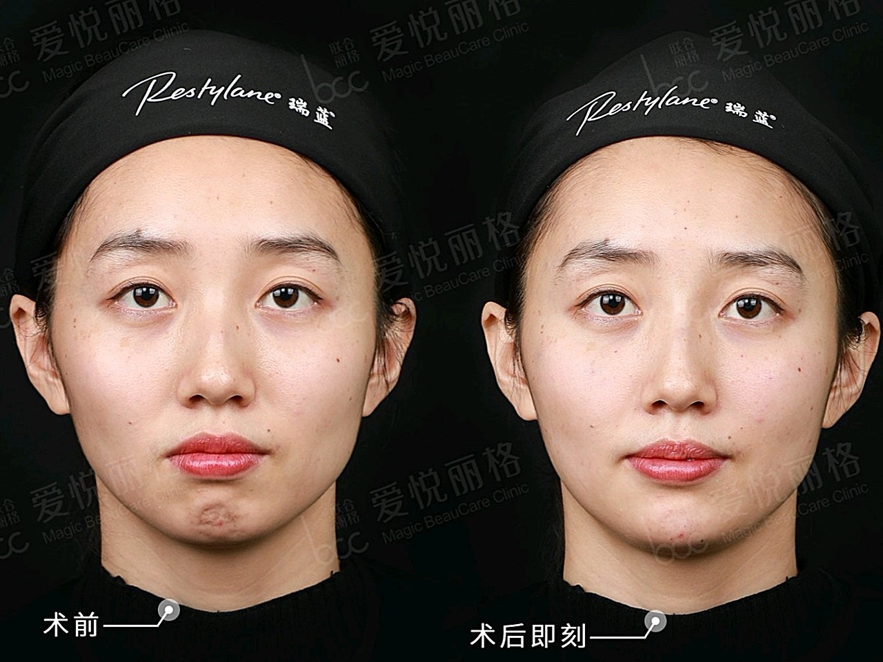 作"铆钉"固定,提升的作用沿泪沟,颧骨三点,鼻翼两侧,嘴角等多个支撑点