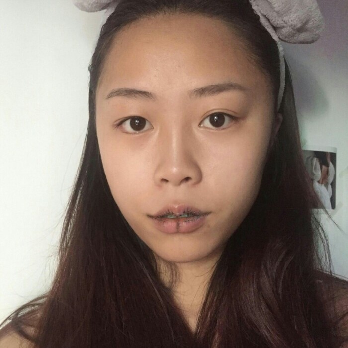 因为脸上的凹陷还有嘴唇的厚重,导致年龄跟我的脸极大_圈子-新氧美容