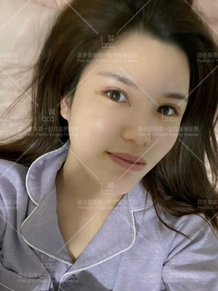 埋线双眼皮修复术后7天