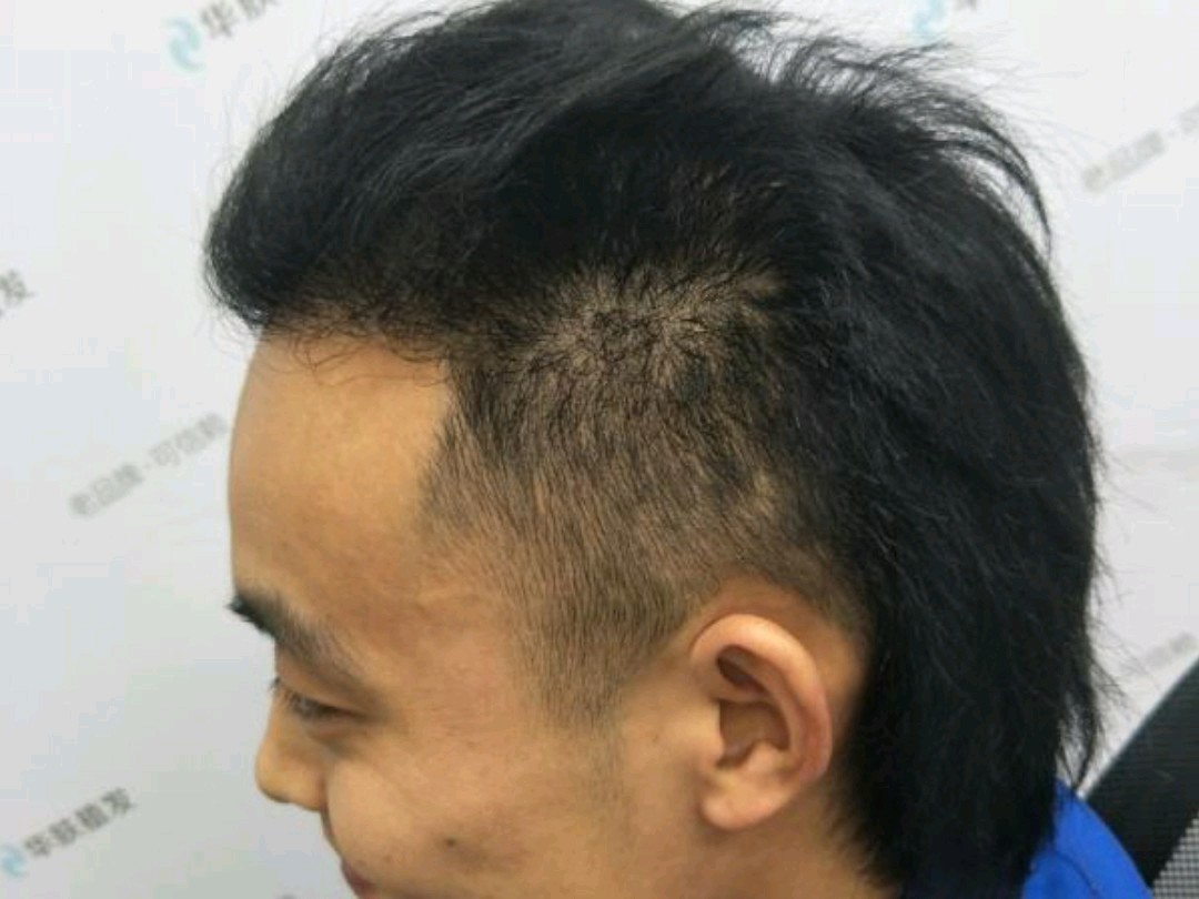 植发后性生活(植发后性生活会怎样)