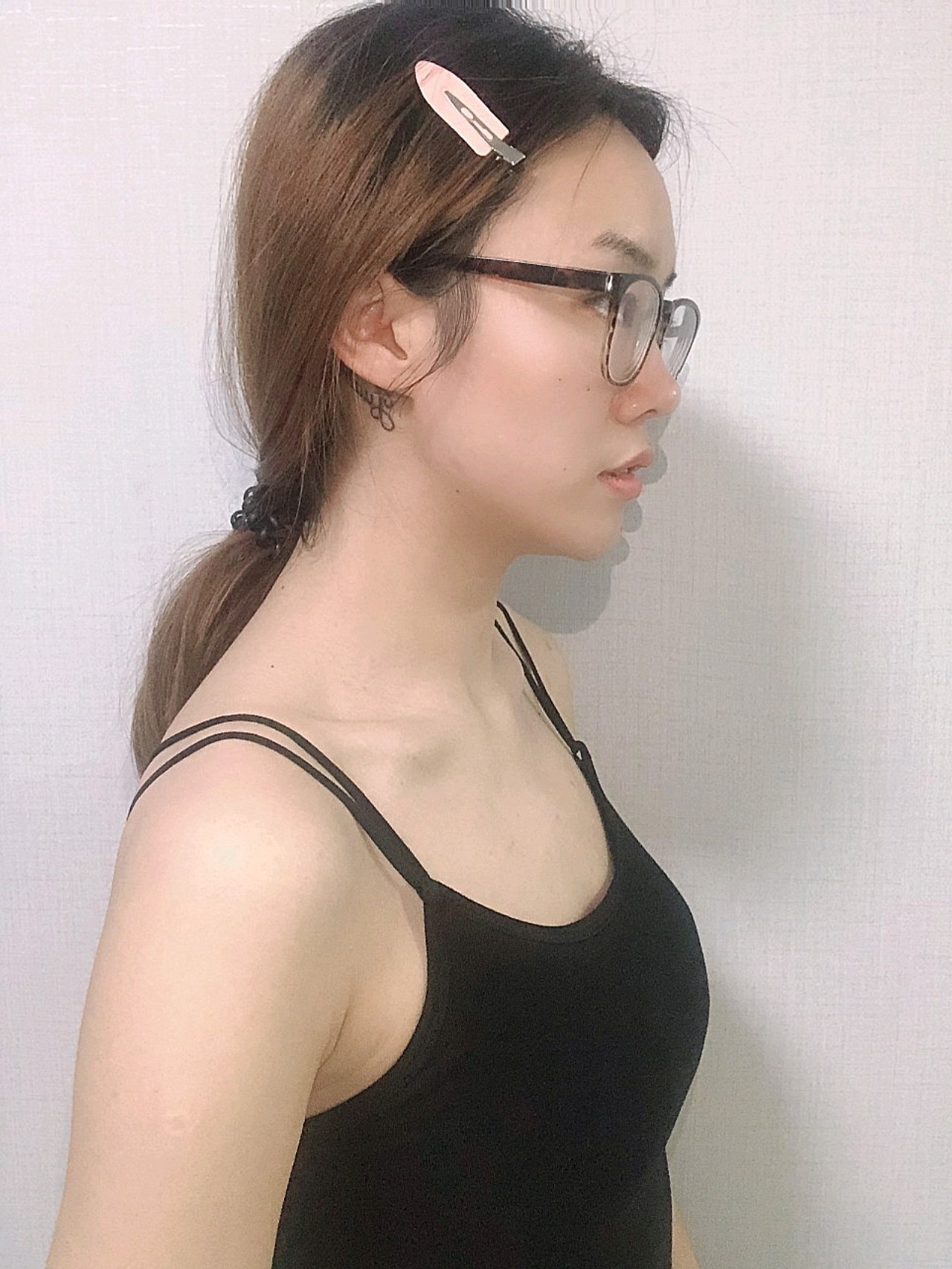 【自体脂肪术后5天】现在是术后第五天啦,之前包着胸_圈子-新氧美容