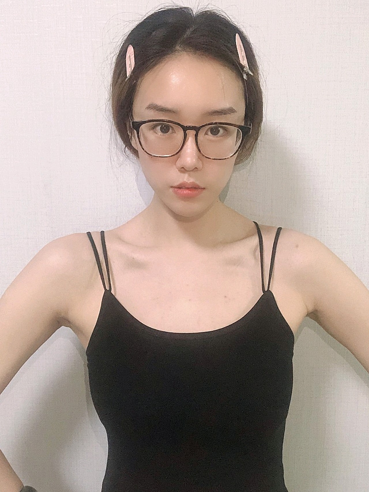 现在是术后第五天啦,之前包着胸部的纱布已经拆掉了,拆掉的时候我也