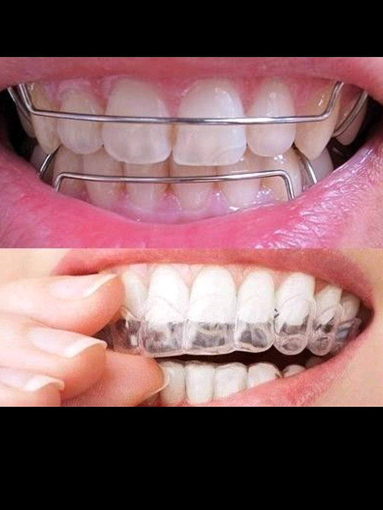 杨颖牙齿进化史