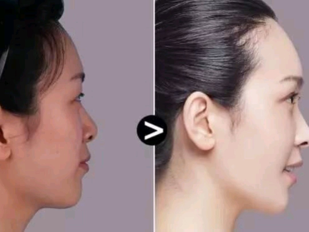 鼻子在五官中是最突出的,所以鼻子好不好看,可以直接_圈子-新氧美容