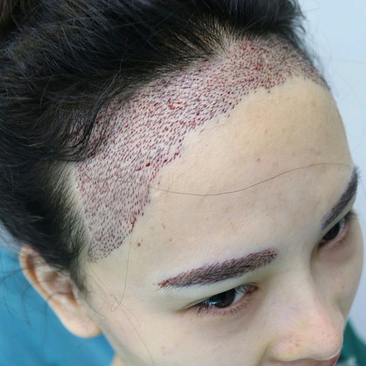 【种植眉毛】【特惠一口价】私信下单可返30% 微针私人定制眉毛 改善