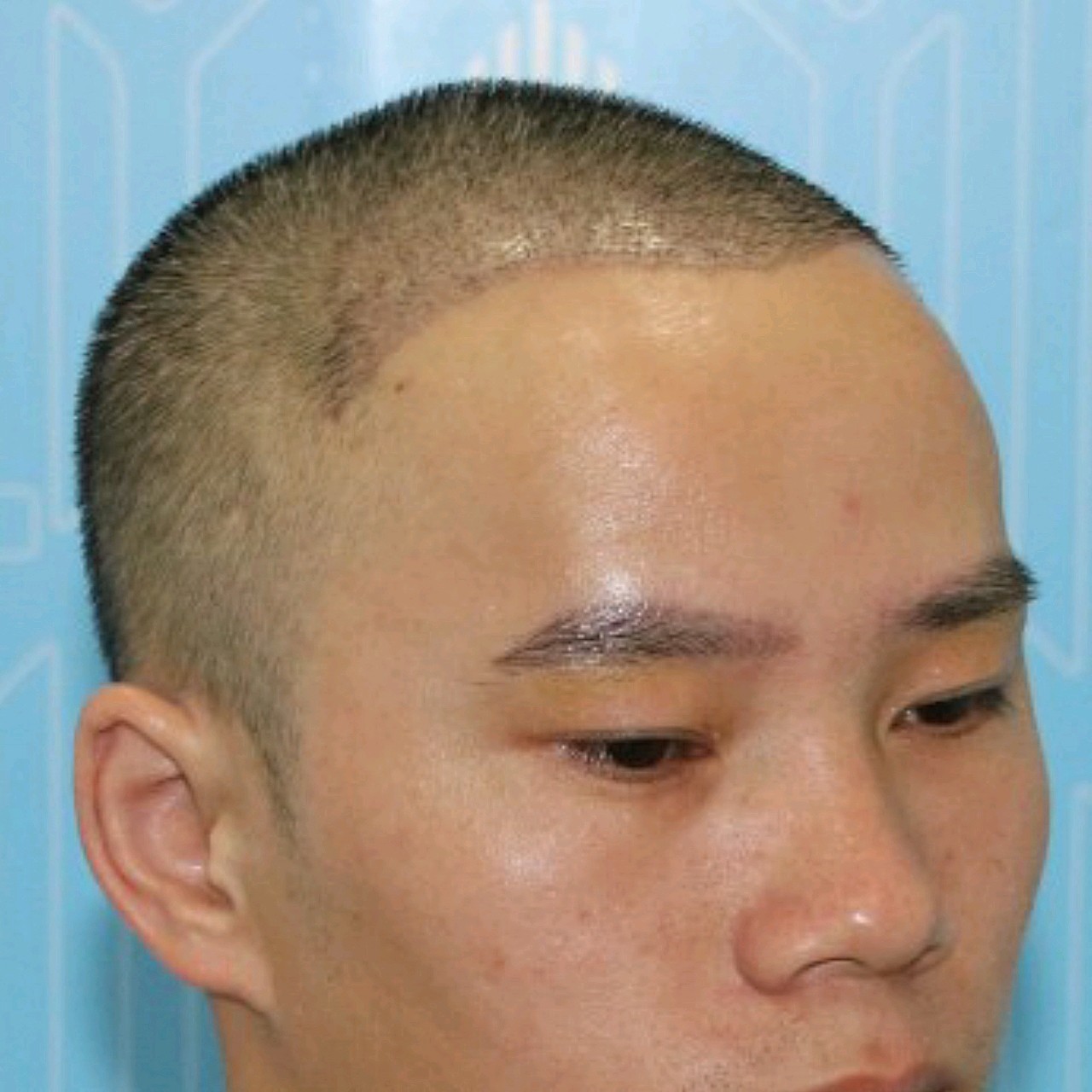 【种植眉毛】【特惠一口价】私信下单可返30% 微针私人定制眉毛 改善