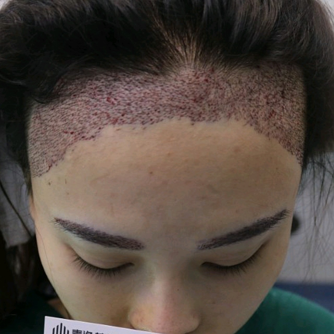 【种植眉毛】【特惠一口价】私信下单可返30% 微针私人定制眉毛 改善