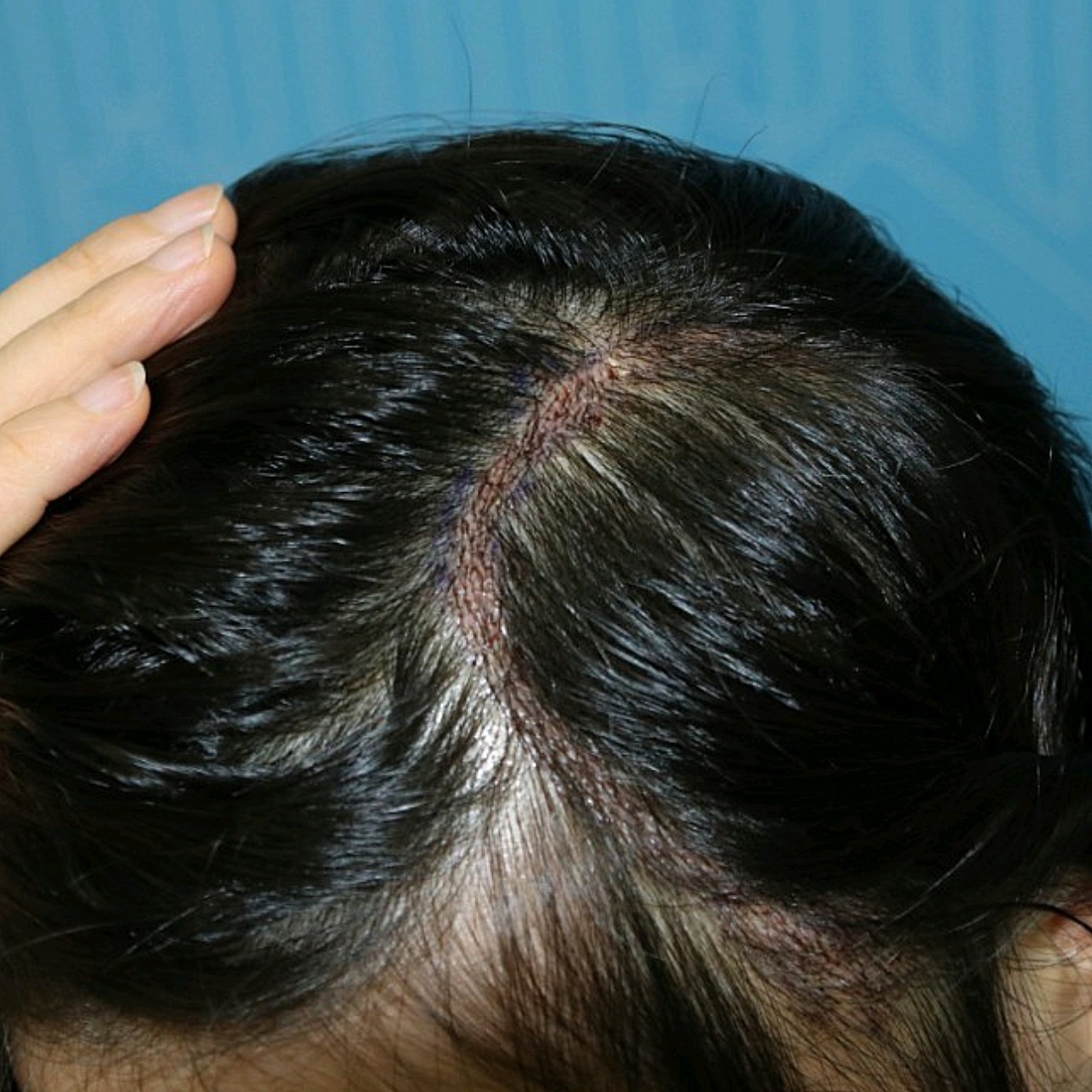 在十六岁那年由于头部受伤又留下了一个c形长长的疤痕_圈子-新氧美容