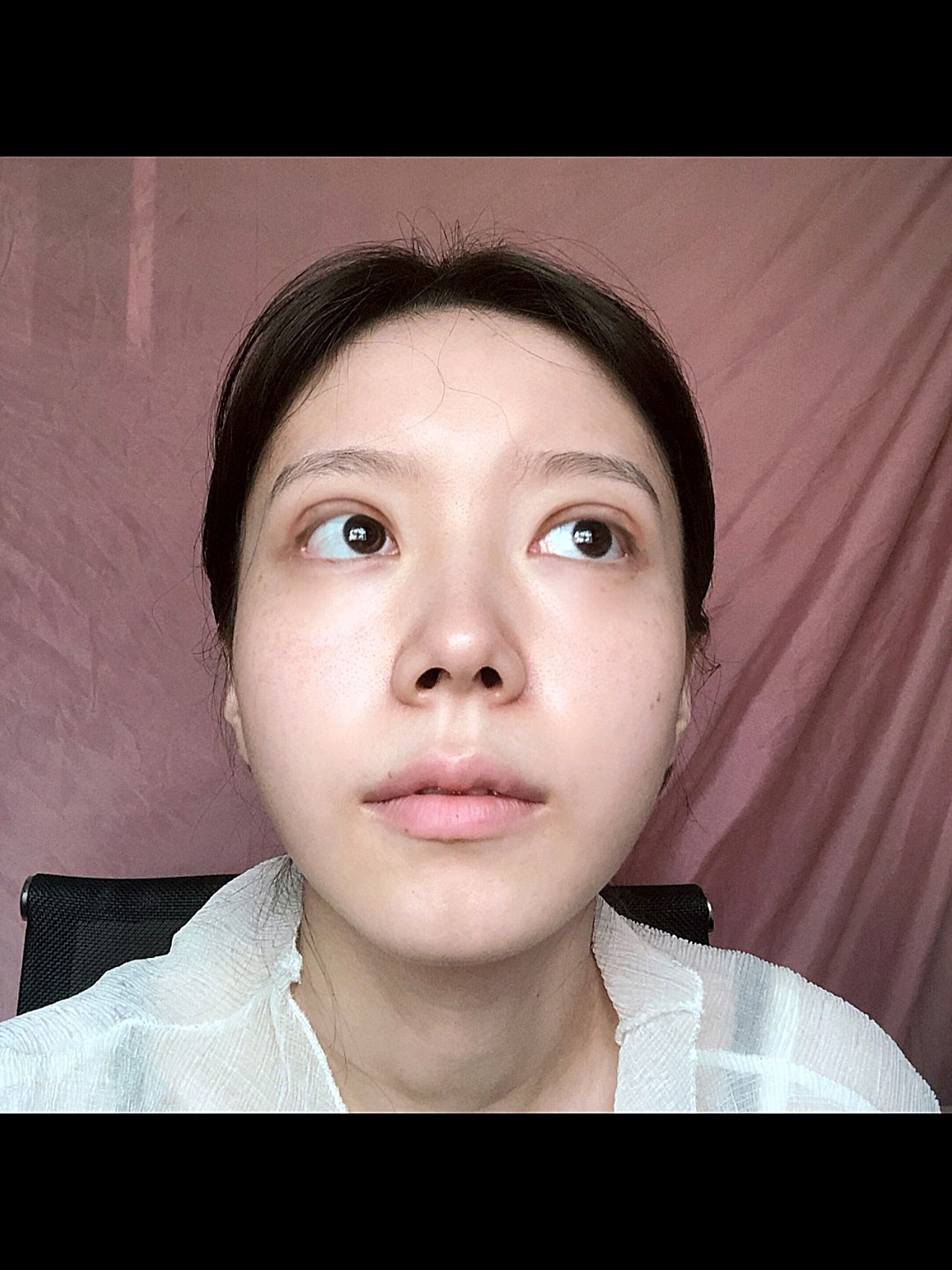 埋线提升项目术后第7天埋线双眼皮已经过去一周时间了_圈子-新氧美容