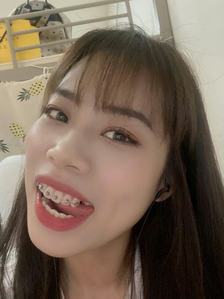 进口金属自锁矫正术后第25天纪念第一次戴牙套,好开_圈子-新氧美容