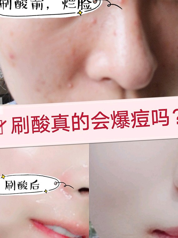 9696相信很多人听说过刷酸会爆痘,_圈子-新氧美容整形
