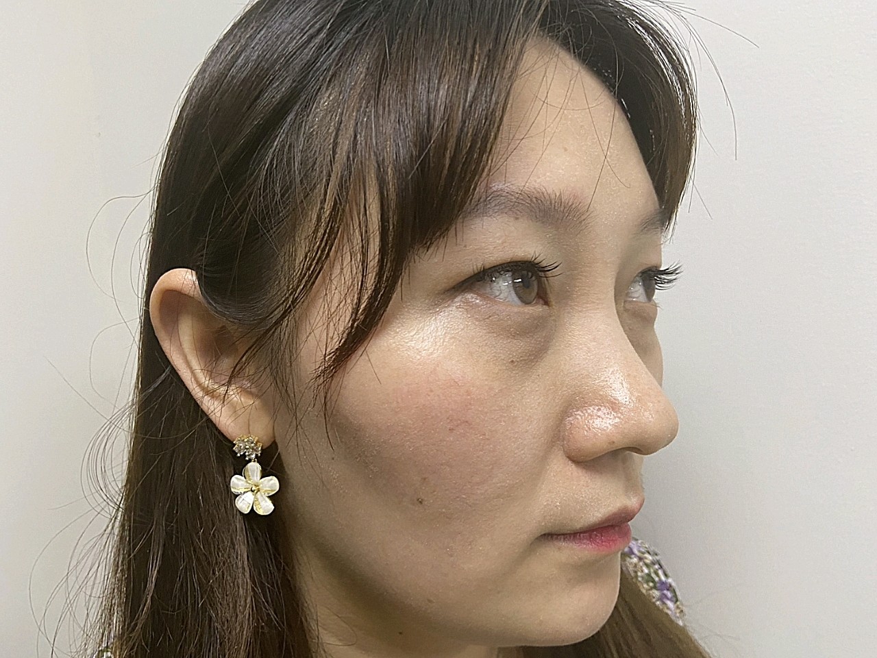 有眼袋就特别显老气,而且眼袋鼓出来一大坨,无论是正_圈子-新氧美容整