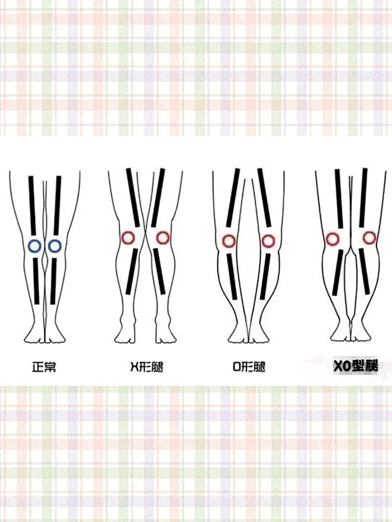 xo型腿如何矫正一