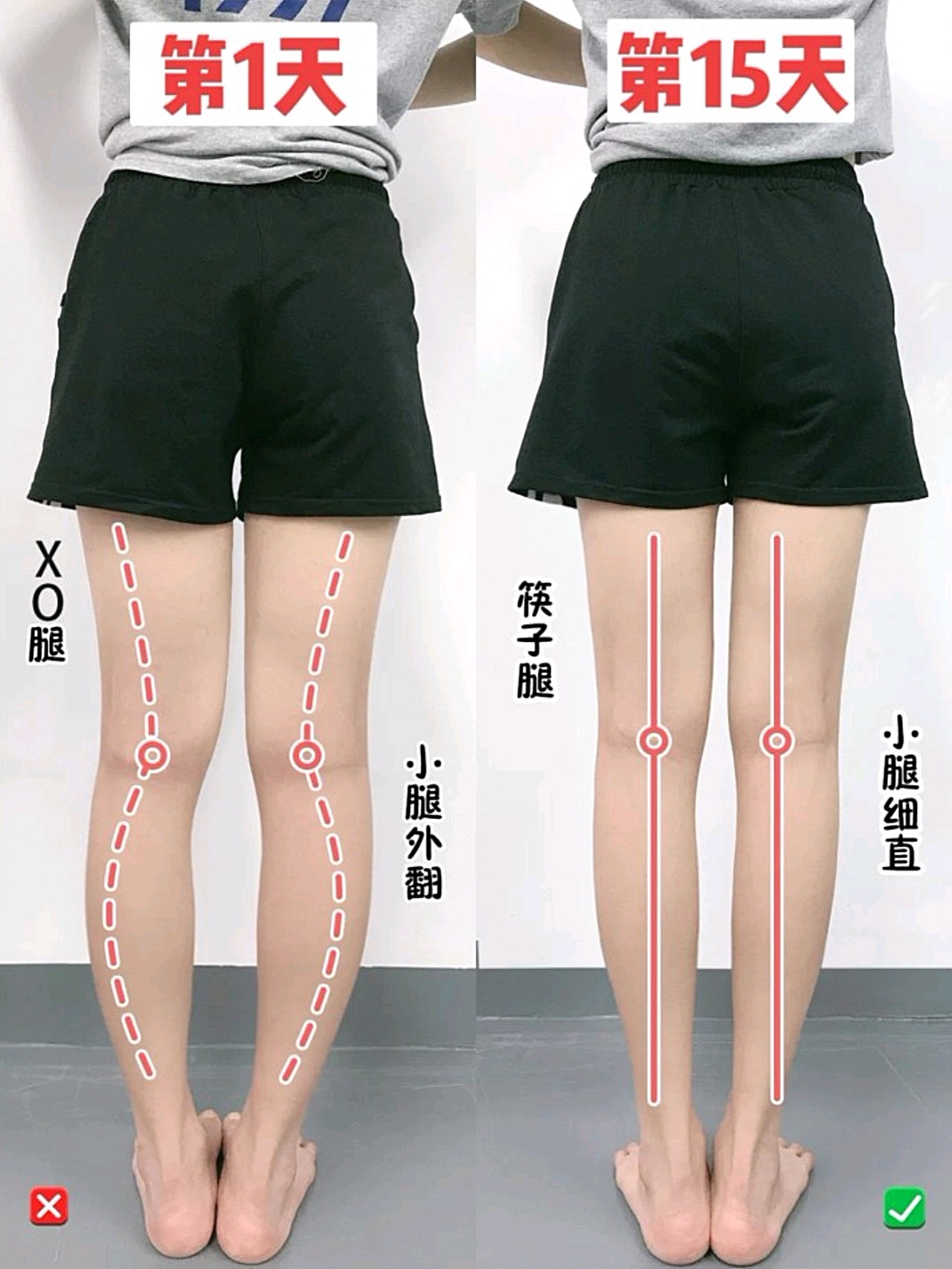 4个动作改善小腿外翻练出细直漫画腿