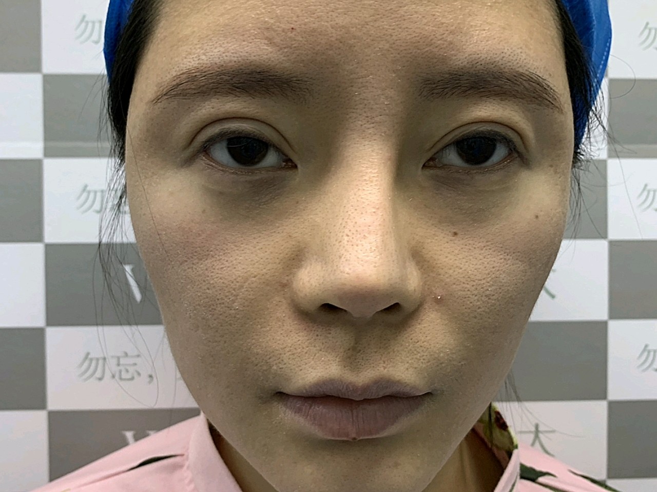 之前的双眼皮有半年了,眼睛有点外突,瞪着的感觉,做_圈子-新氧美容