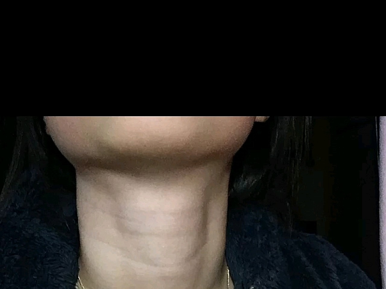 【沈阳汇美人嗨体去颈纹第49天】