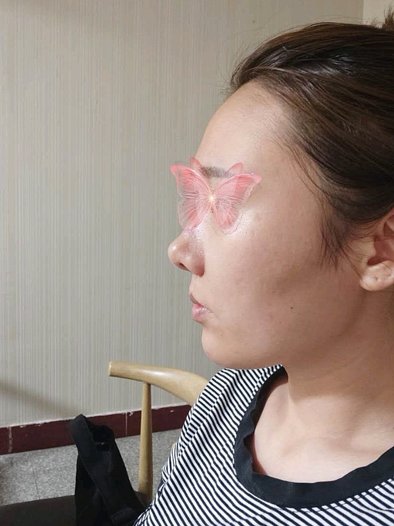 鼻基底术后一个月97个人感受:鼻基底手术是在嘴里面切_圈子-新氧