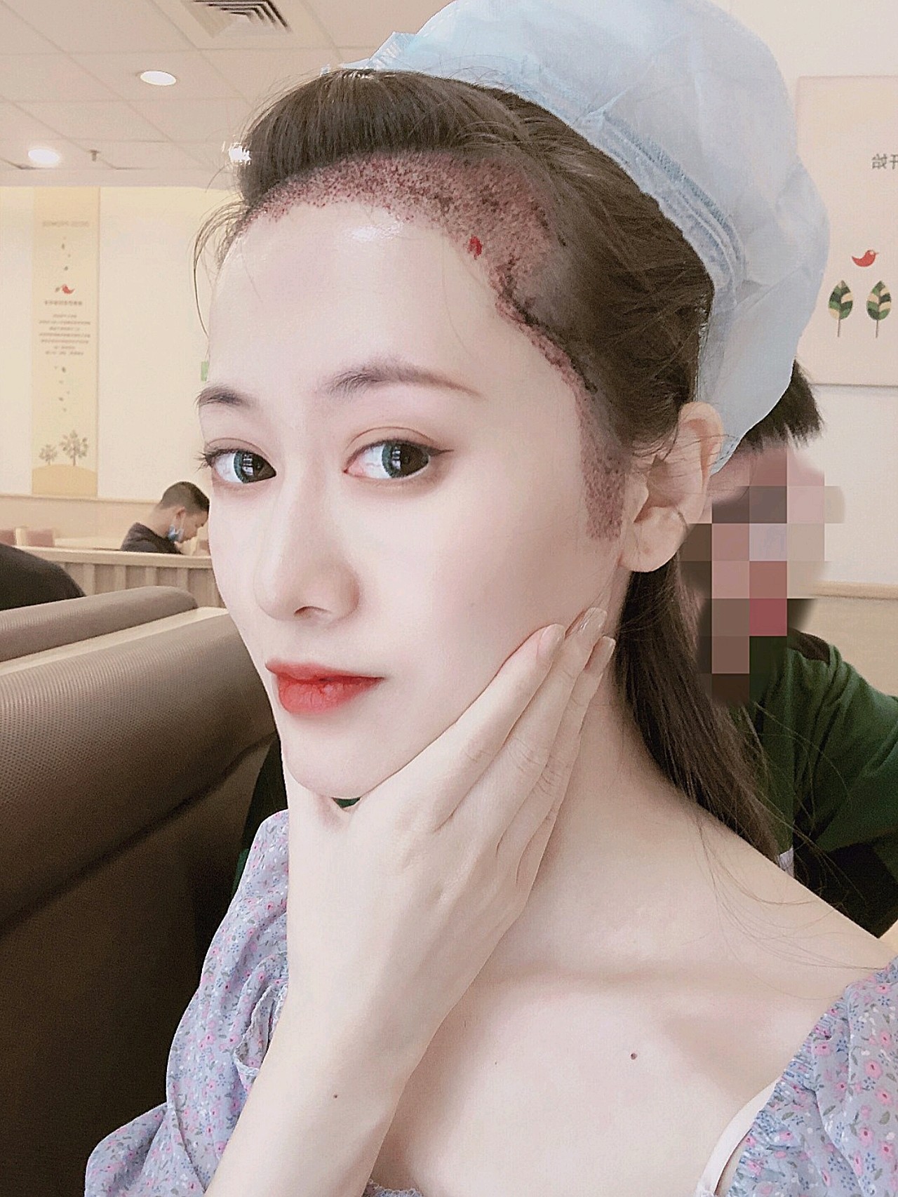 早就知道首瑞做植发比较好,也有朋友来过,长了一年后效果不错后.