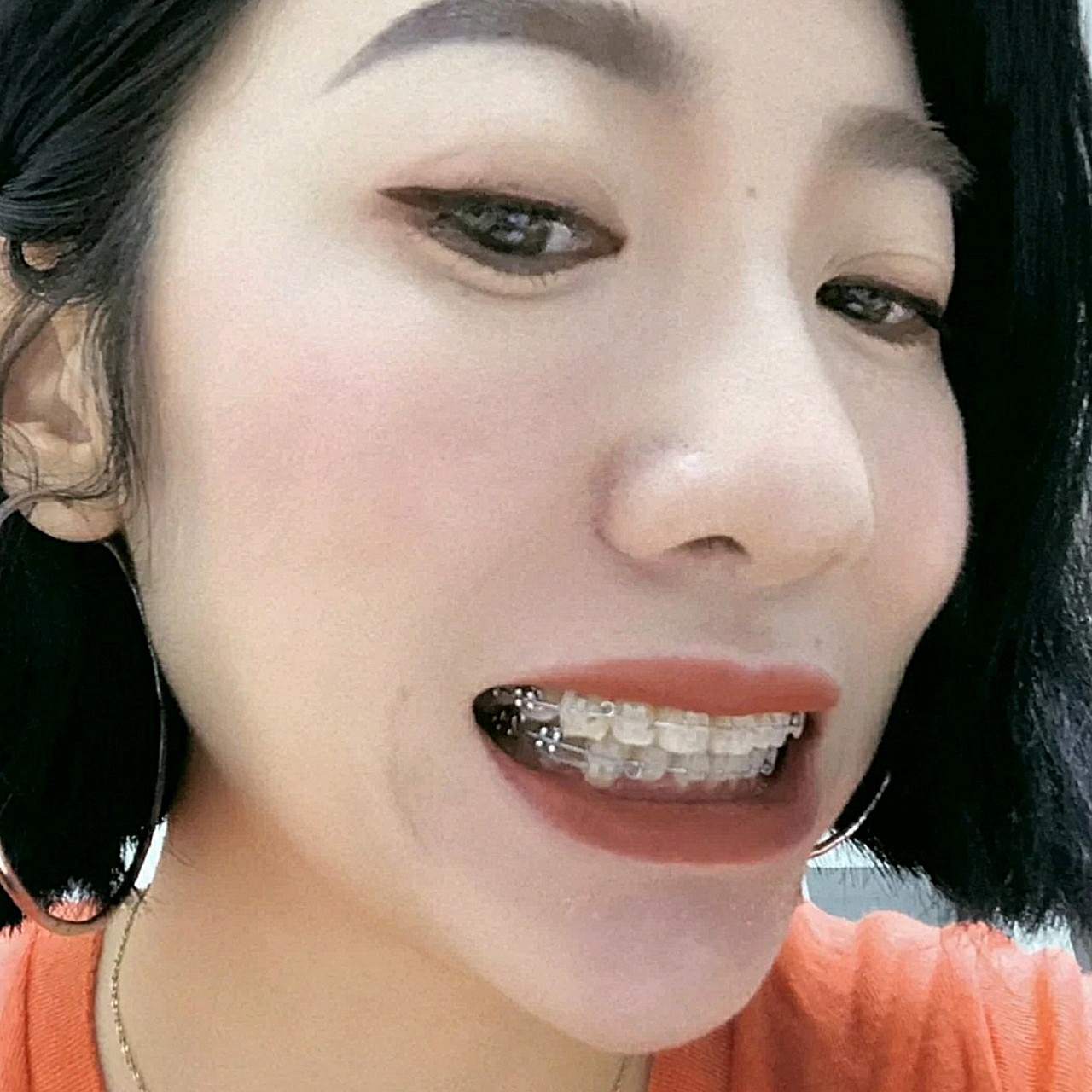 我带的是半隐形陶瓷托槽,1万多价位