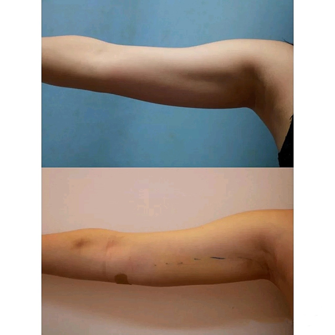 不知道手臂还能不能再瘦下去把手垂直平放看起来就跟抽之前差不多