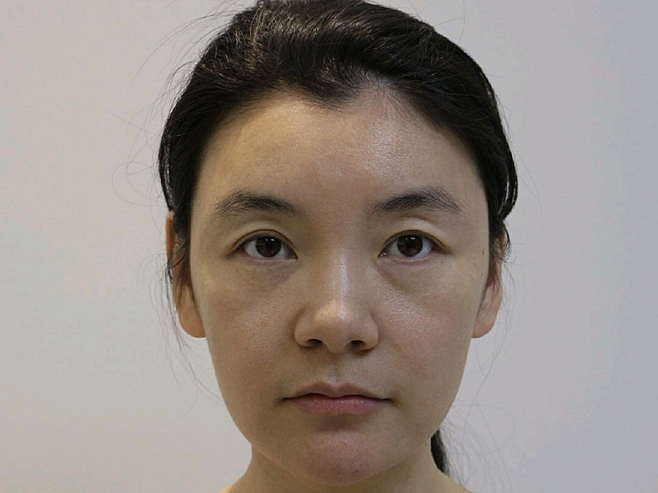 脸下垂了真的是老10岁,泪沟严重 法令纹也深,莫医_圈子-新氧美容整形