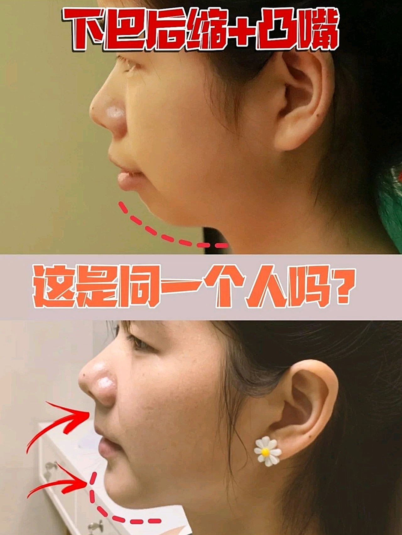 导致上唇短厚翘起,下颌后缩,牙齿拥挤,上切牙突出,脖子前倾