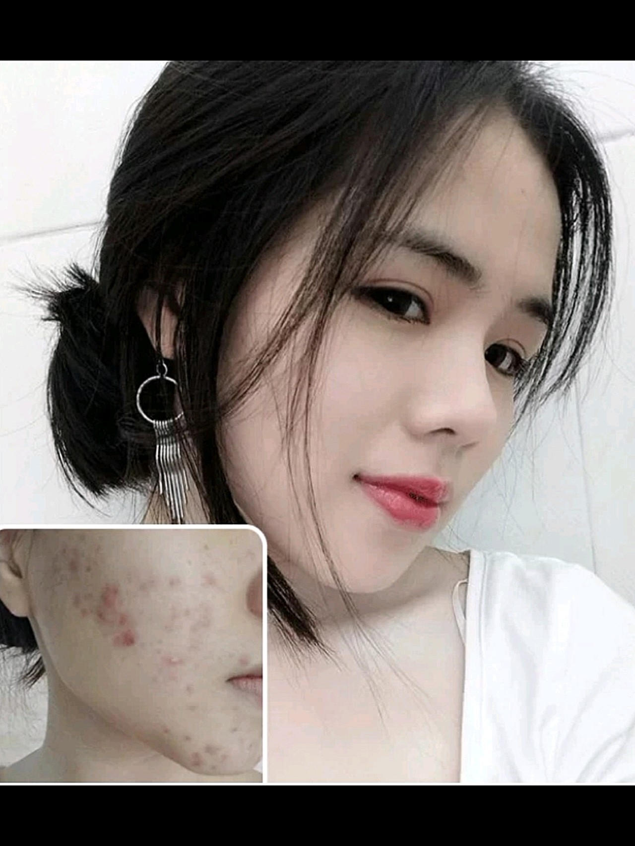 祛痘几年,医生开的平价祛痘膏!