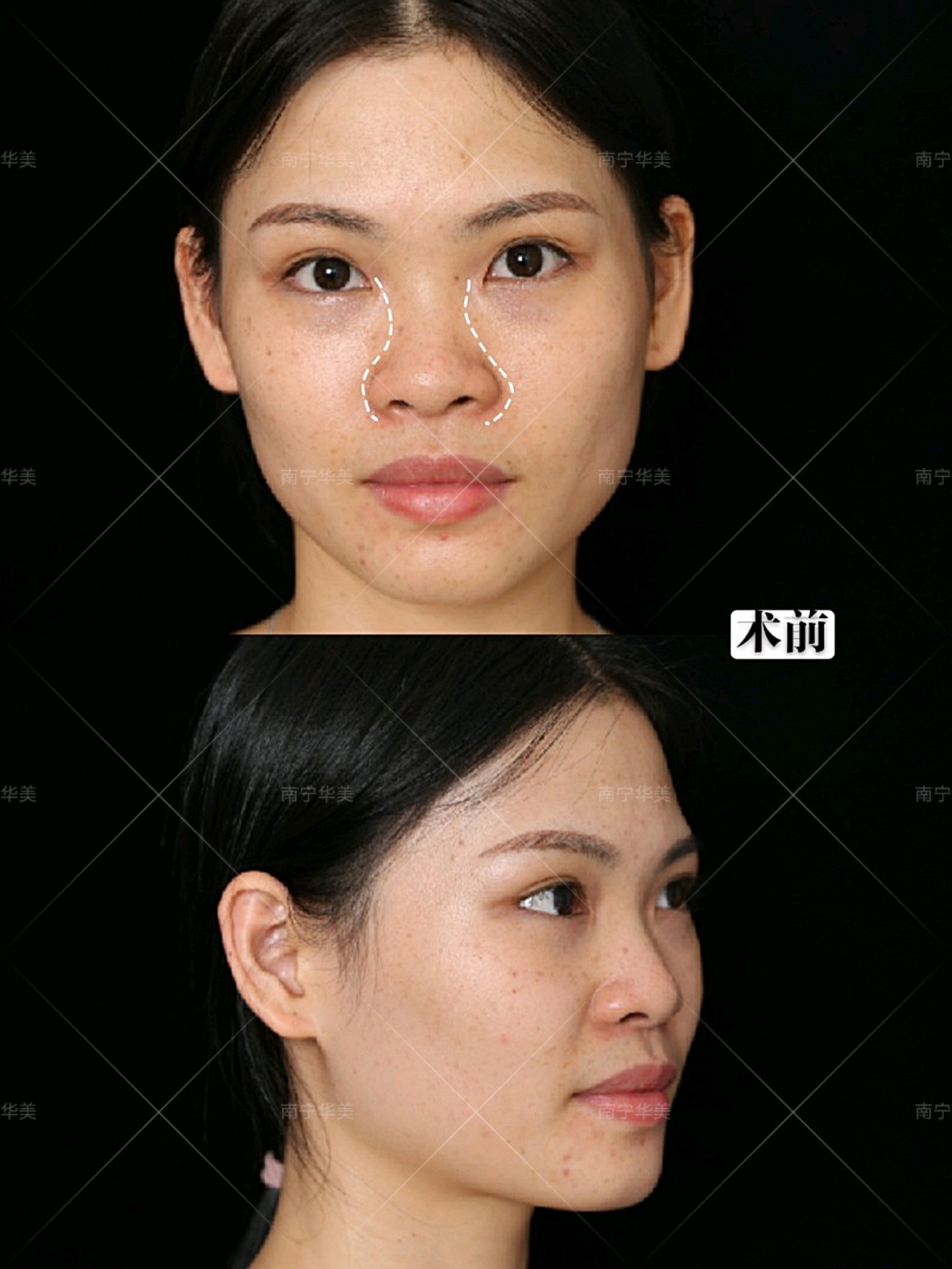 60156015自然美越来越受大家的推崇,鼻子也一样,原生_圈子