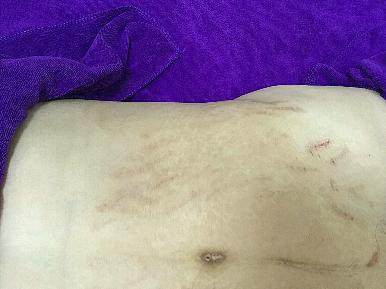 我个人认为妊娠纹还是早治疗见效快,最近看到一个刚生_圈子-新氧美容