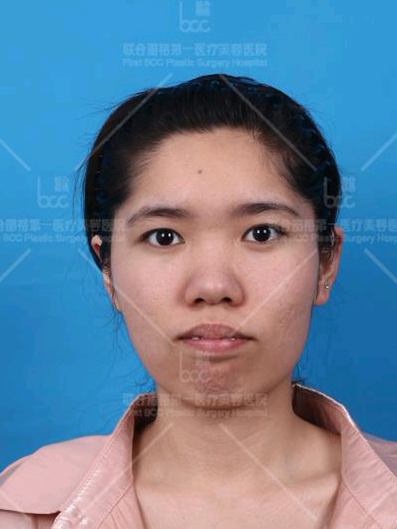 上颌前突矫正术后5天