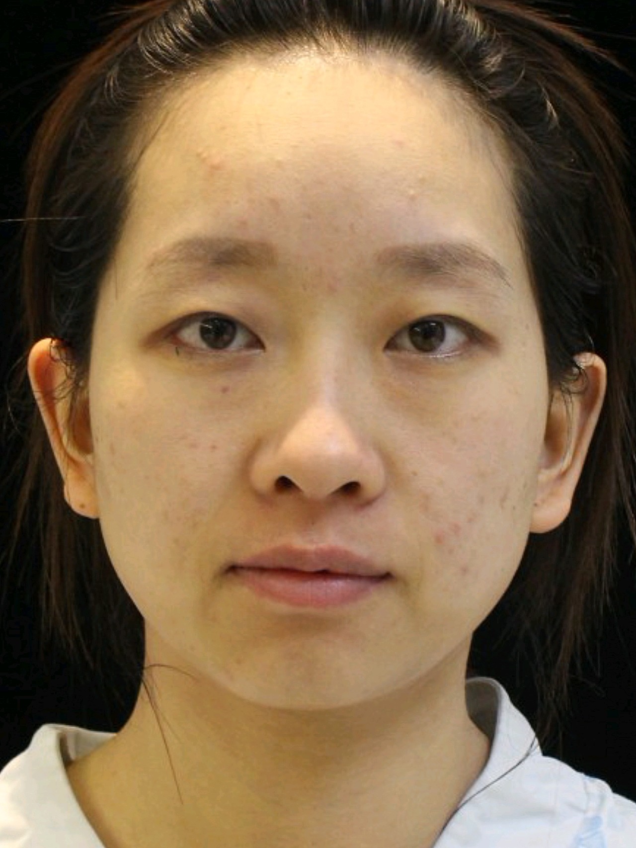 年轻型泪沟及眼袋怎么解决?