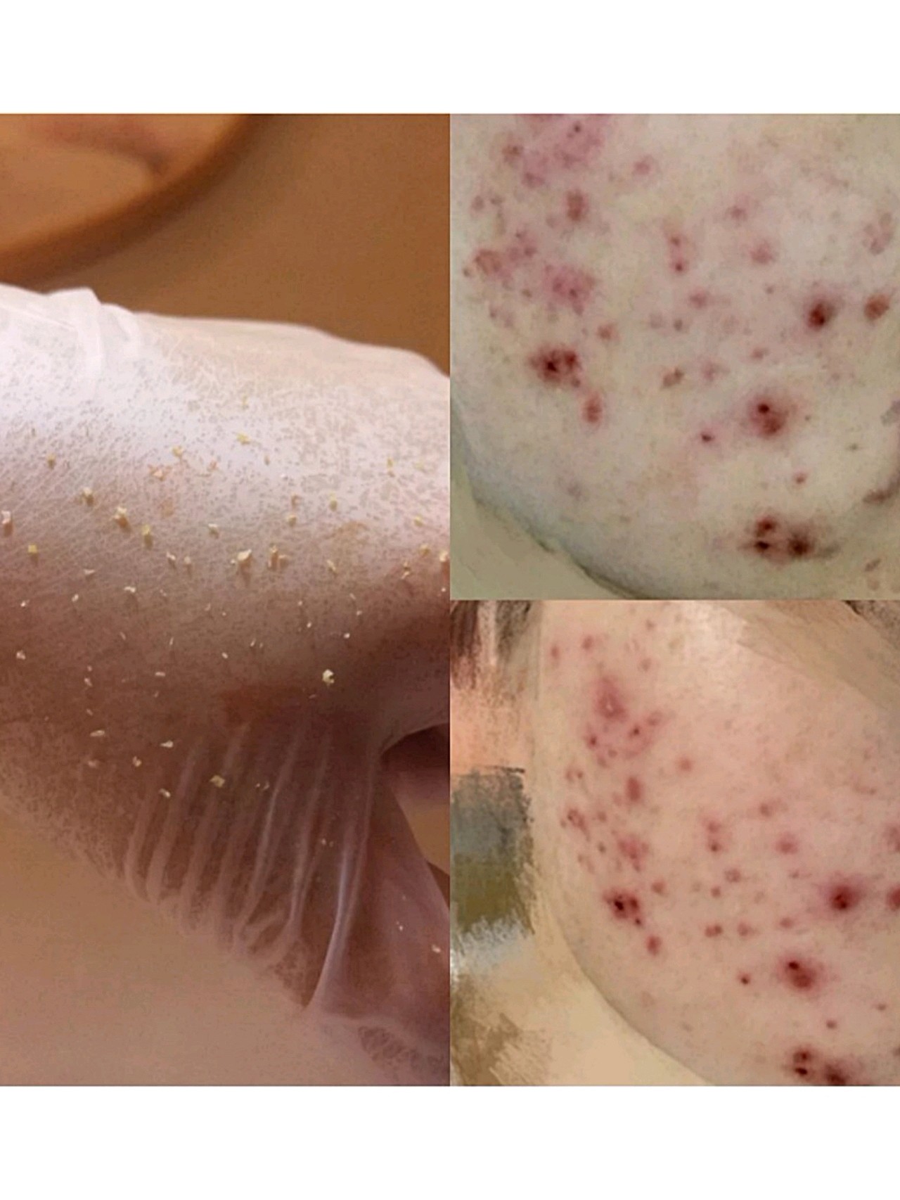 闭口痘痘太多试试针清