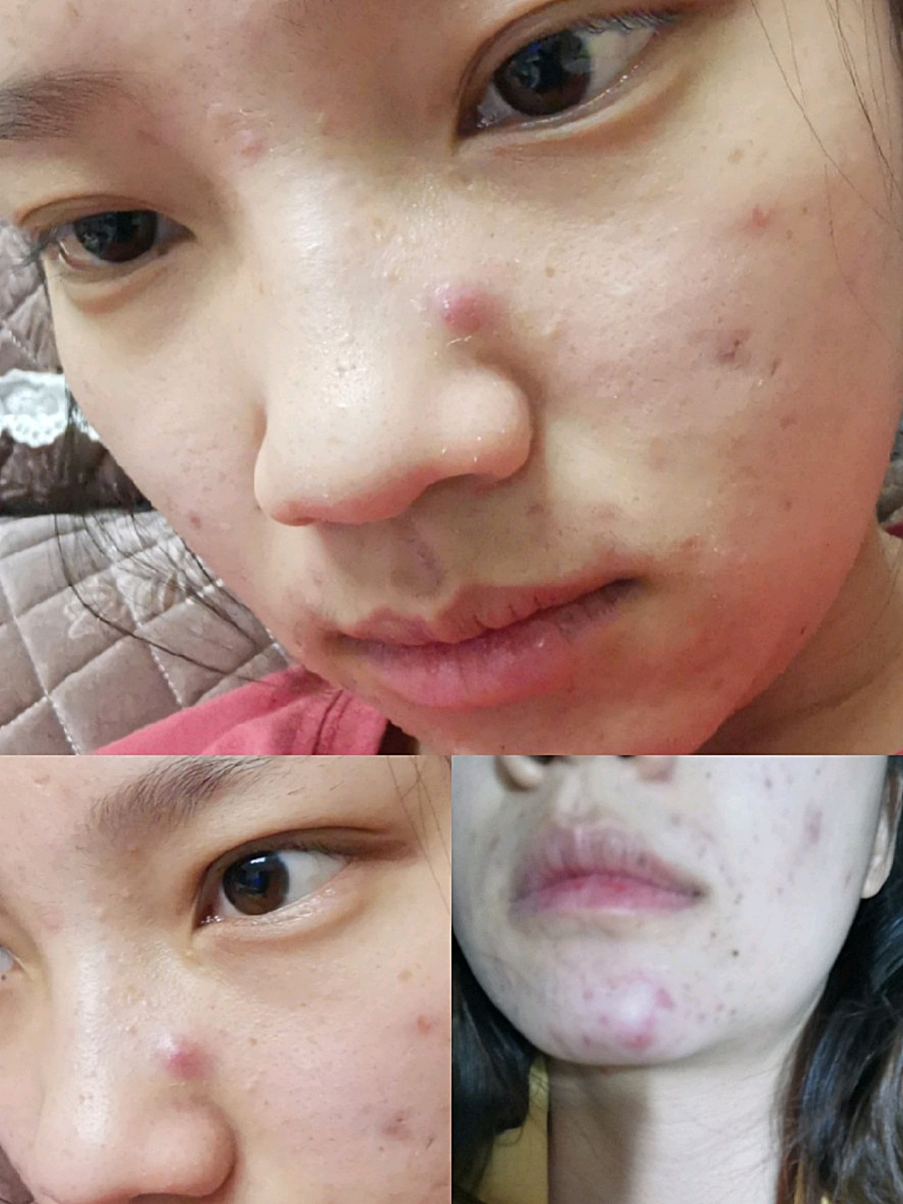 闭口痘痘太多试试针清