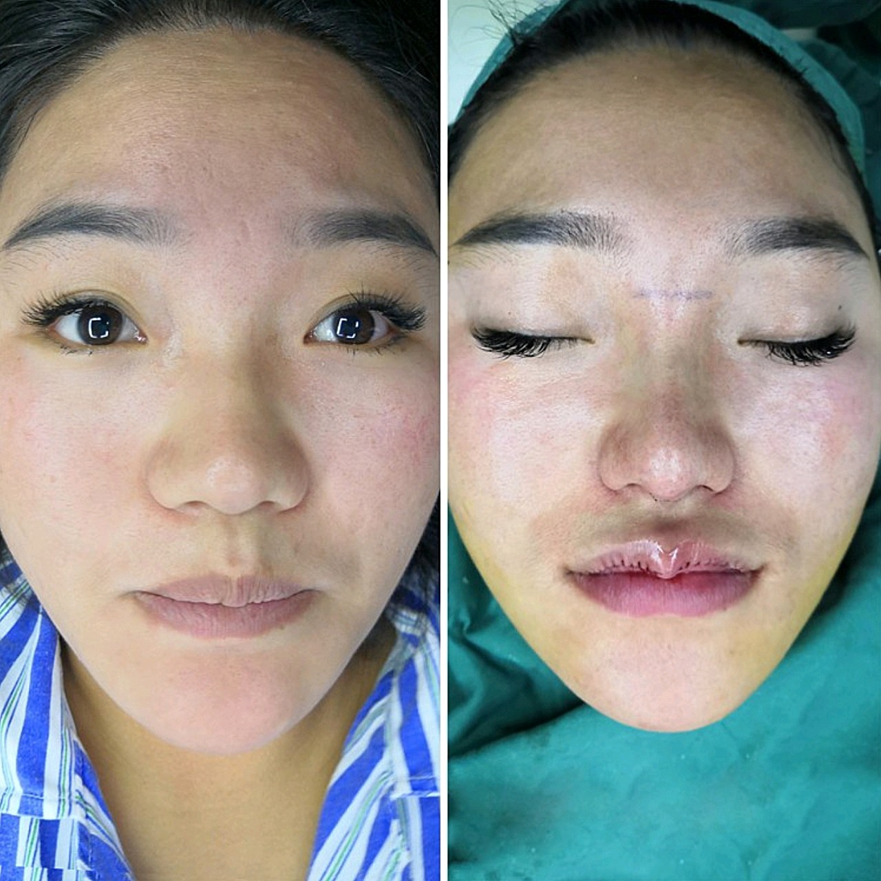 拆线啦,现在我的唇部虽然得到了很明显的改善,不过