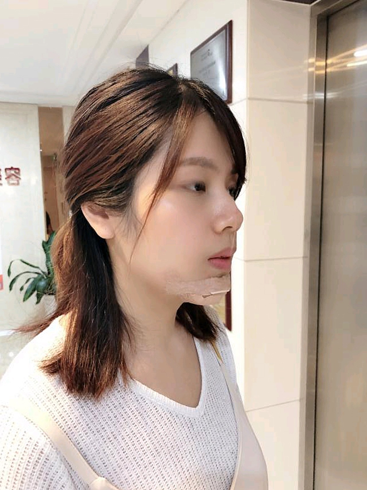 做完假体垫下巴也有几天了,现在下巴感觉有些肿胀感,_圈子-新氧美容