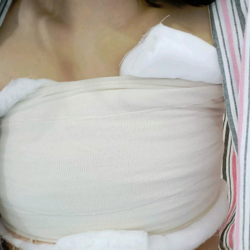 乳房手术包扎图片