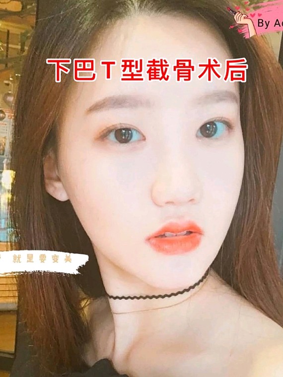 下巴t型截骨术后反馈分享96原来下巴宽大并且不对称,_圈子-新氧美容