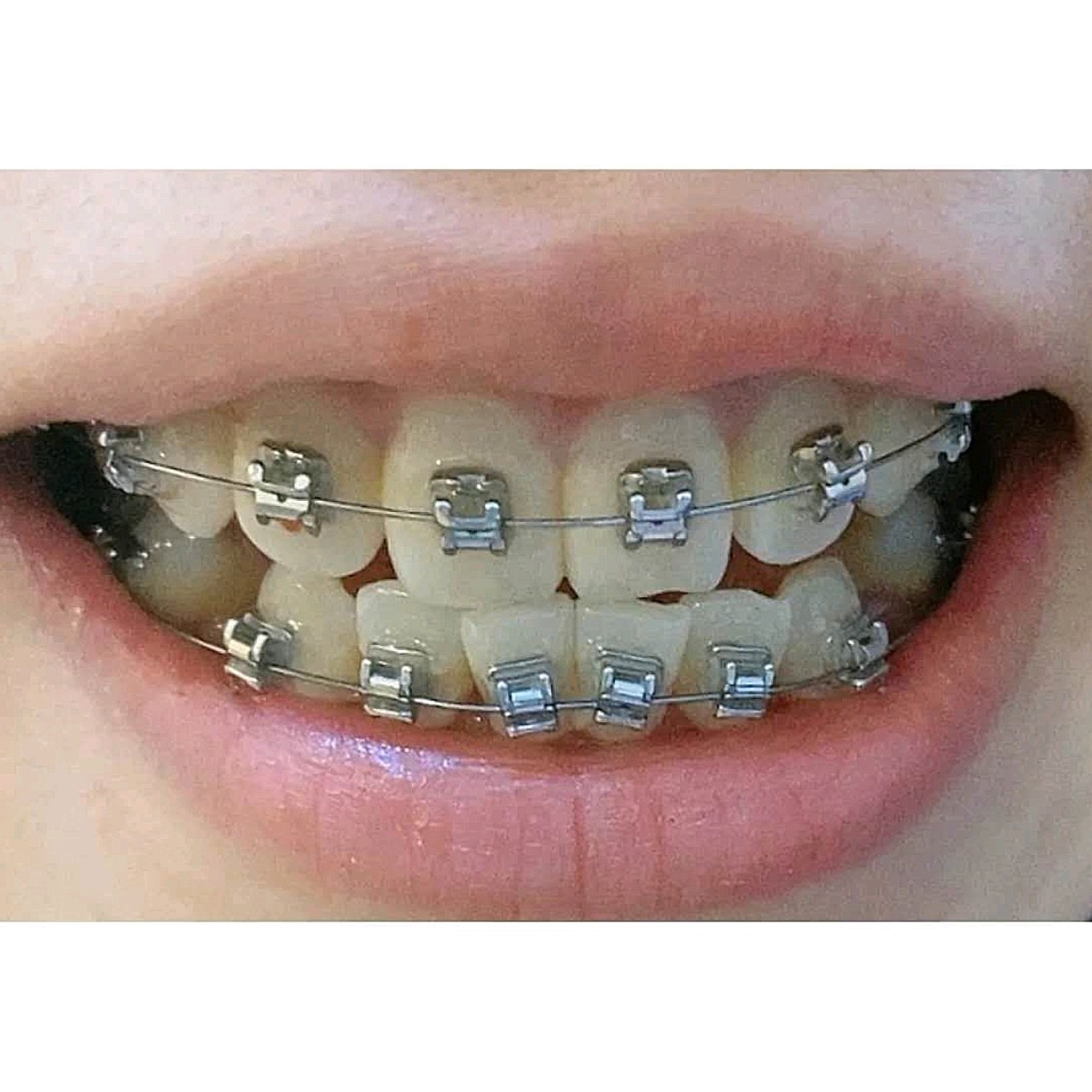 牙套是什么样子的图片图片