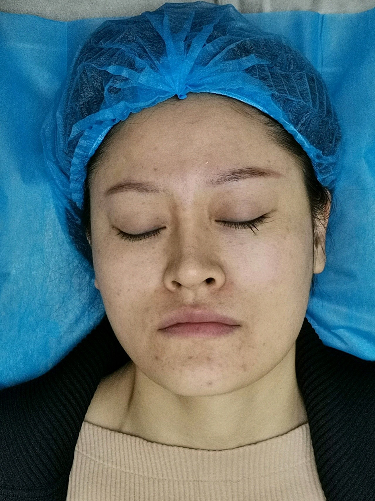 俪人超皮秒术后第2天 !