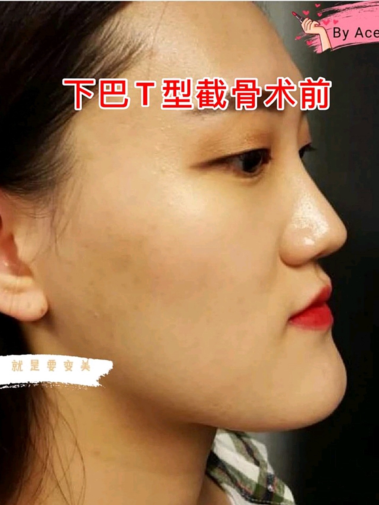 下巴t型截骨术后反馈分享