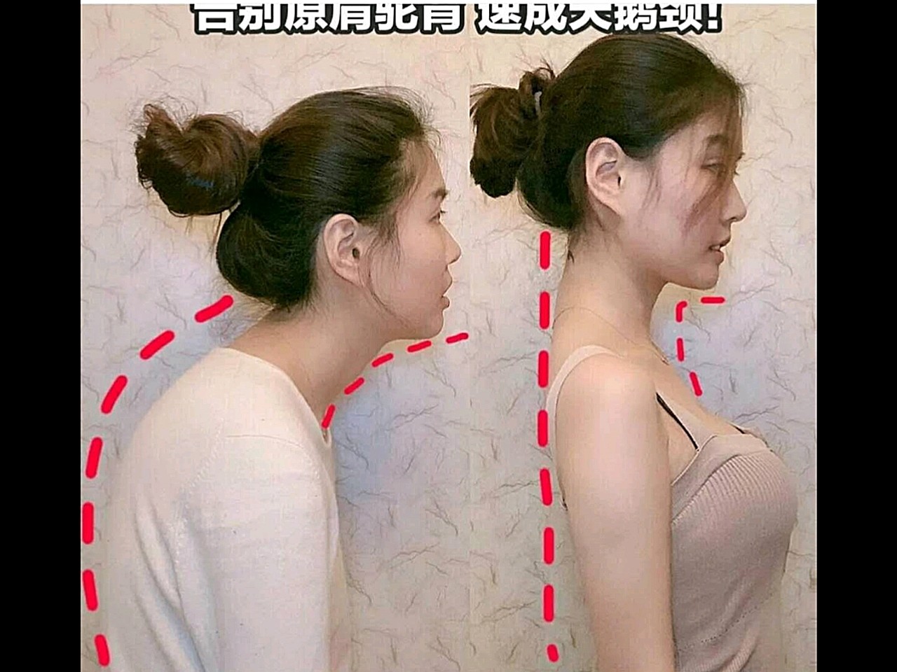 6个动作矫正圆肩驼背脖子前倾消除斜方肌 长时间的驼背会导致肩膀变厚