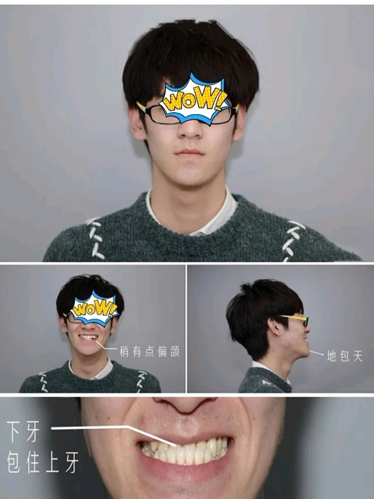 最强科普牙齿畸形,凸嘴该如何矫正