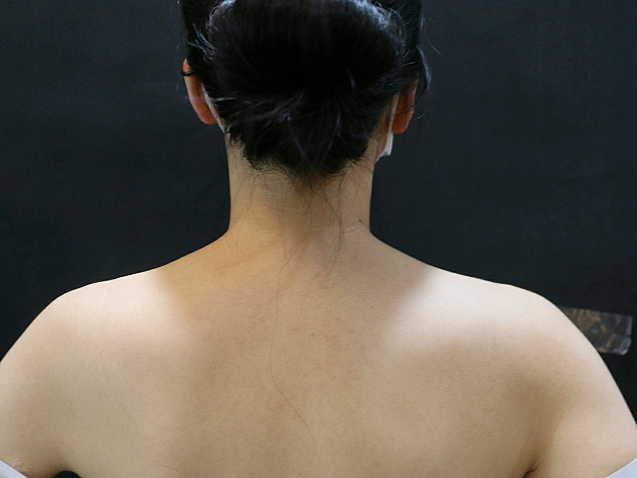 这是我瘦肩针的术前照片,本人比较瘦,肩胛骨高,上身_圈子-新氧美容