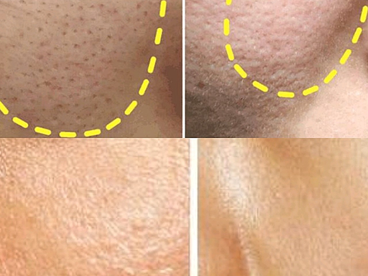 93毛孔粗大的问题真的是许多爱美人士的困扰,尤其夏日_圈子-新氧