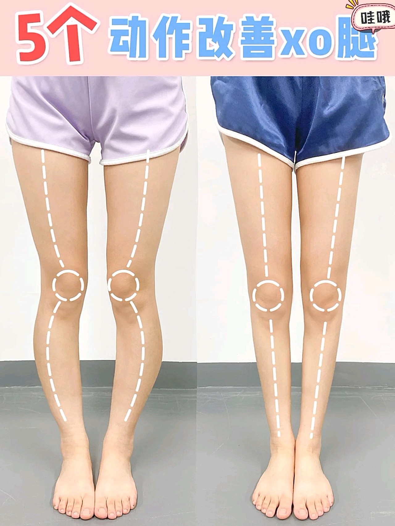 5个动作改善xo腿/养成细长直