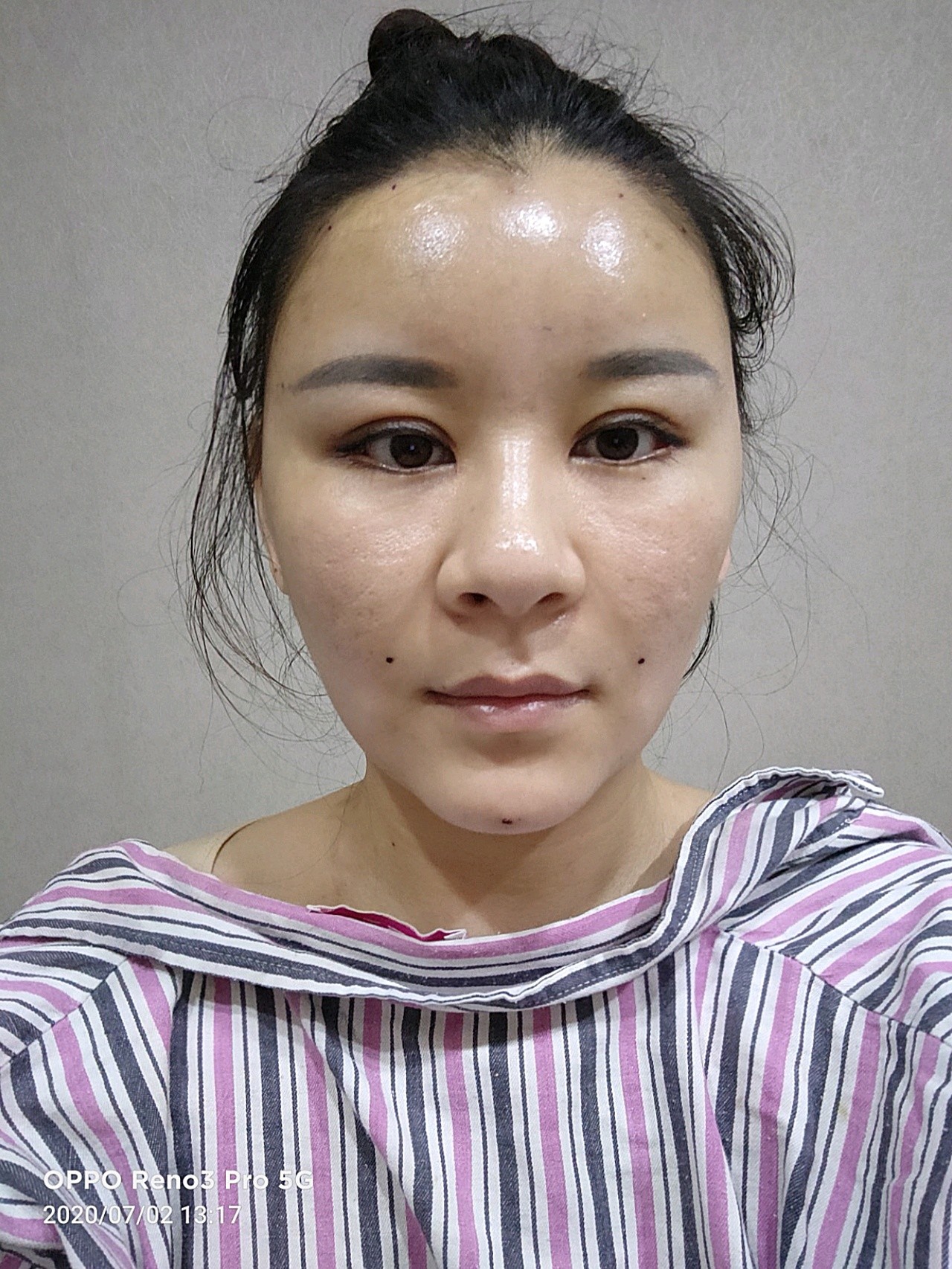 脂肪填充的第三天已经消肿了哦看的也很好看,原相机