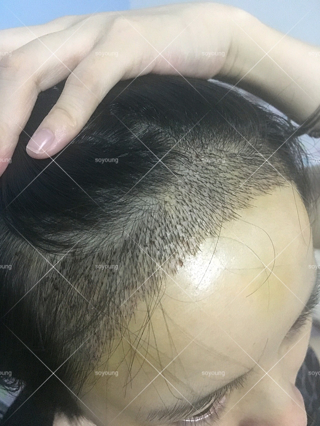 植发后疯长期(植发后会不会又掉了)