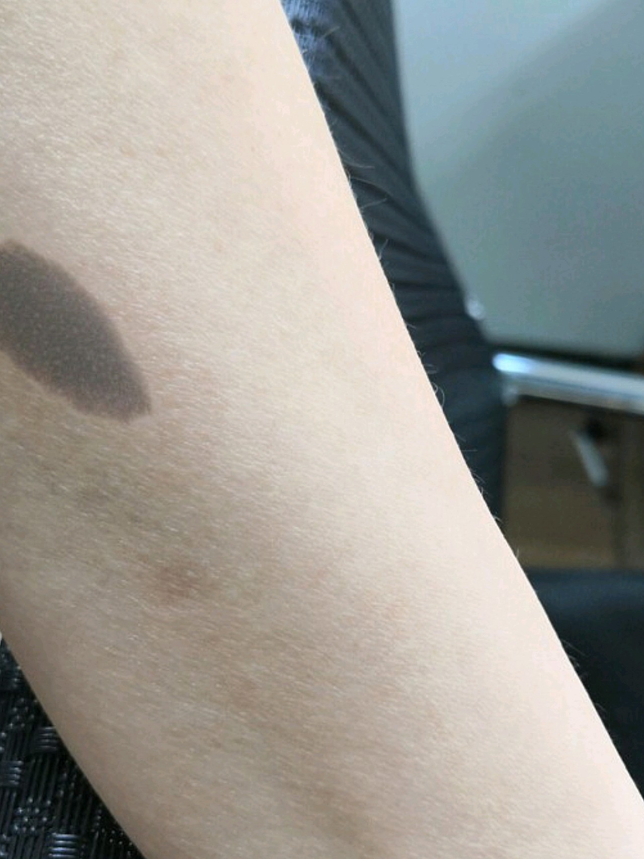 今天来做了第一次治疗,我的主要问题是胳膊上长了黑毛痣,面积不是很大